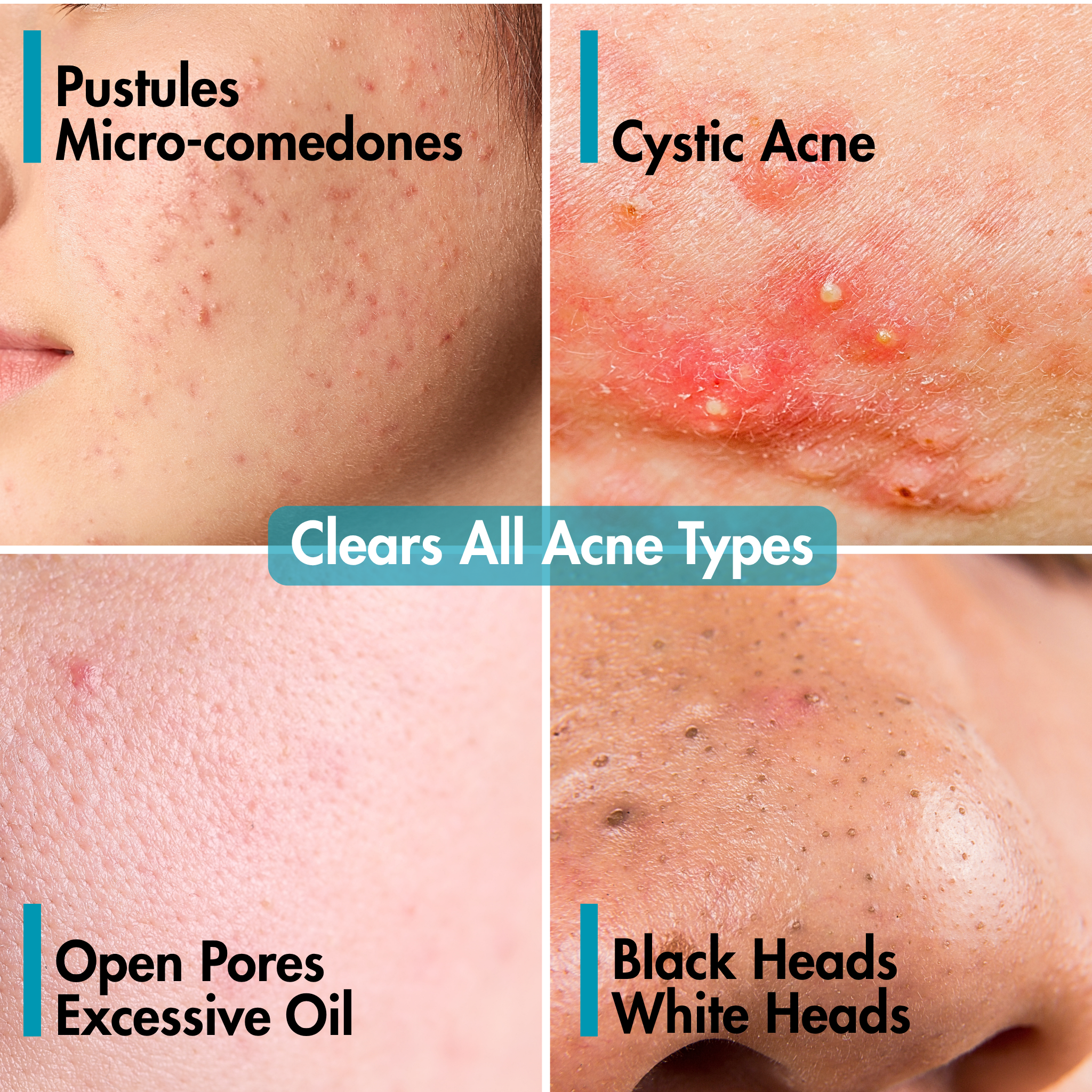 Ultimate Clear Anti - Acne Kit