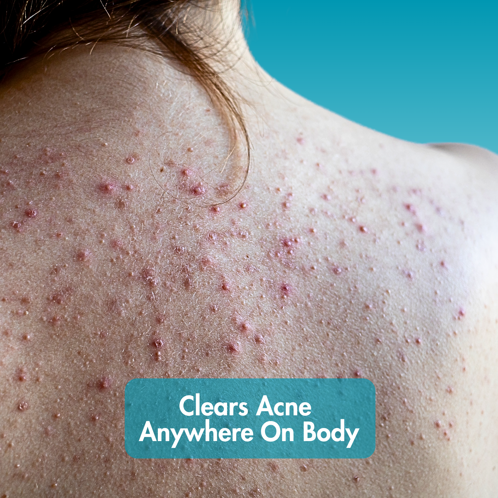 Ultimate Clear Anti - Acne Kit