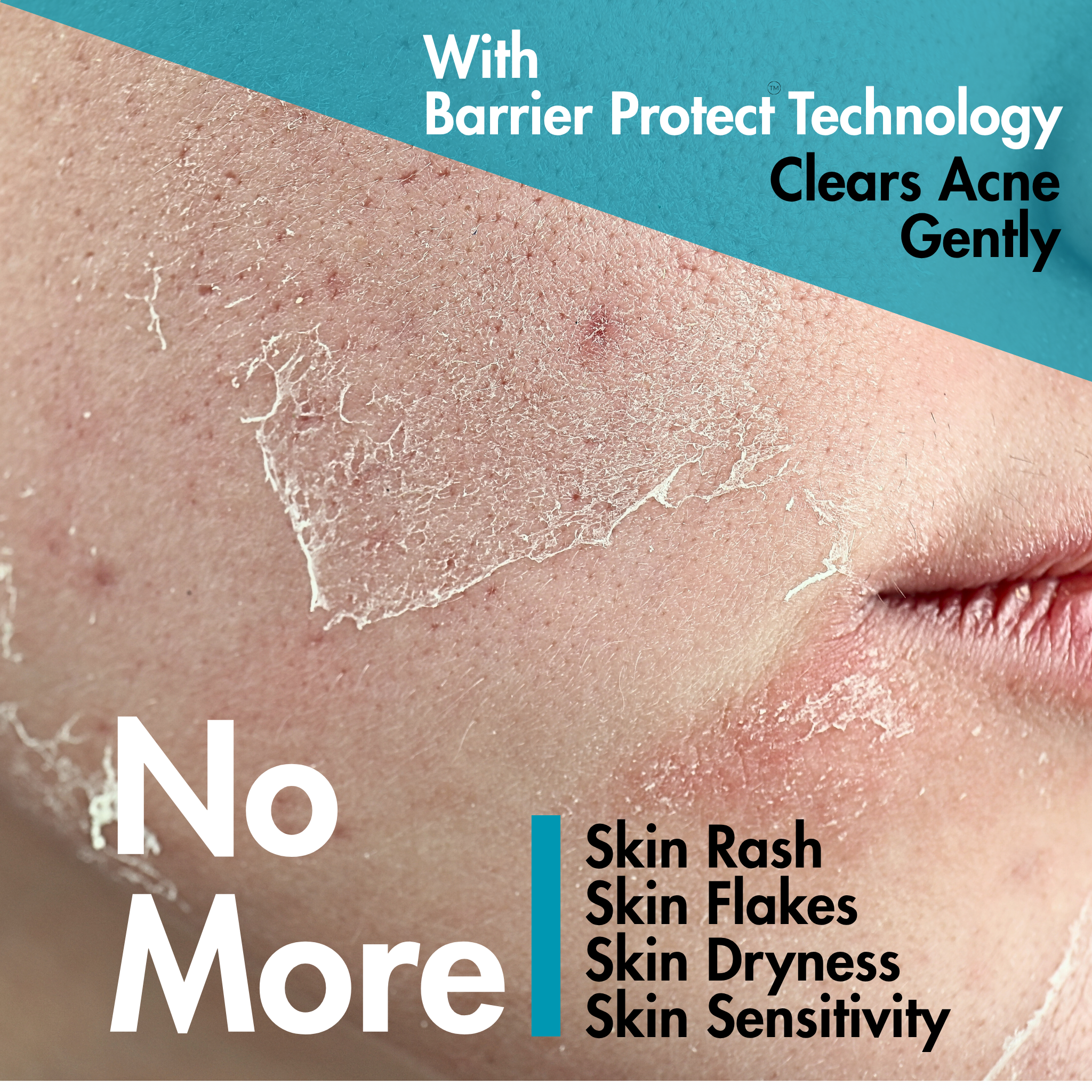 Ultimate Clear Anti - Acne Kit