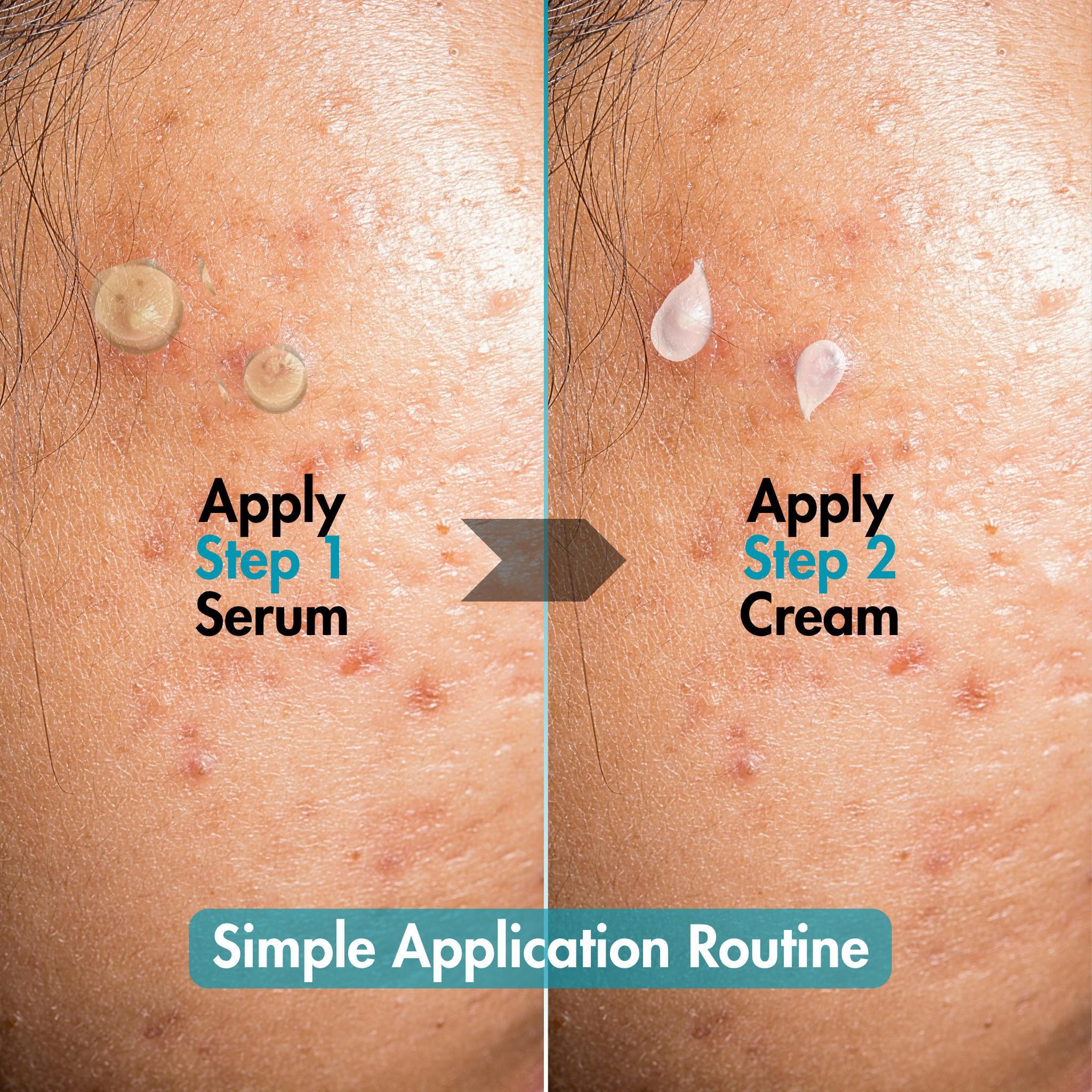 Ultimate Clear Anti - Acne Kit