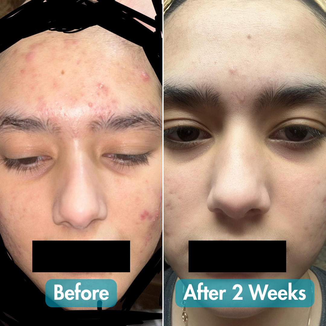 Ultimate Clear Anti - Acne Kit