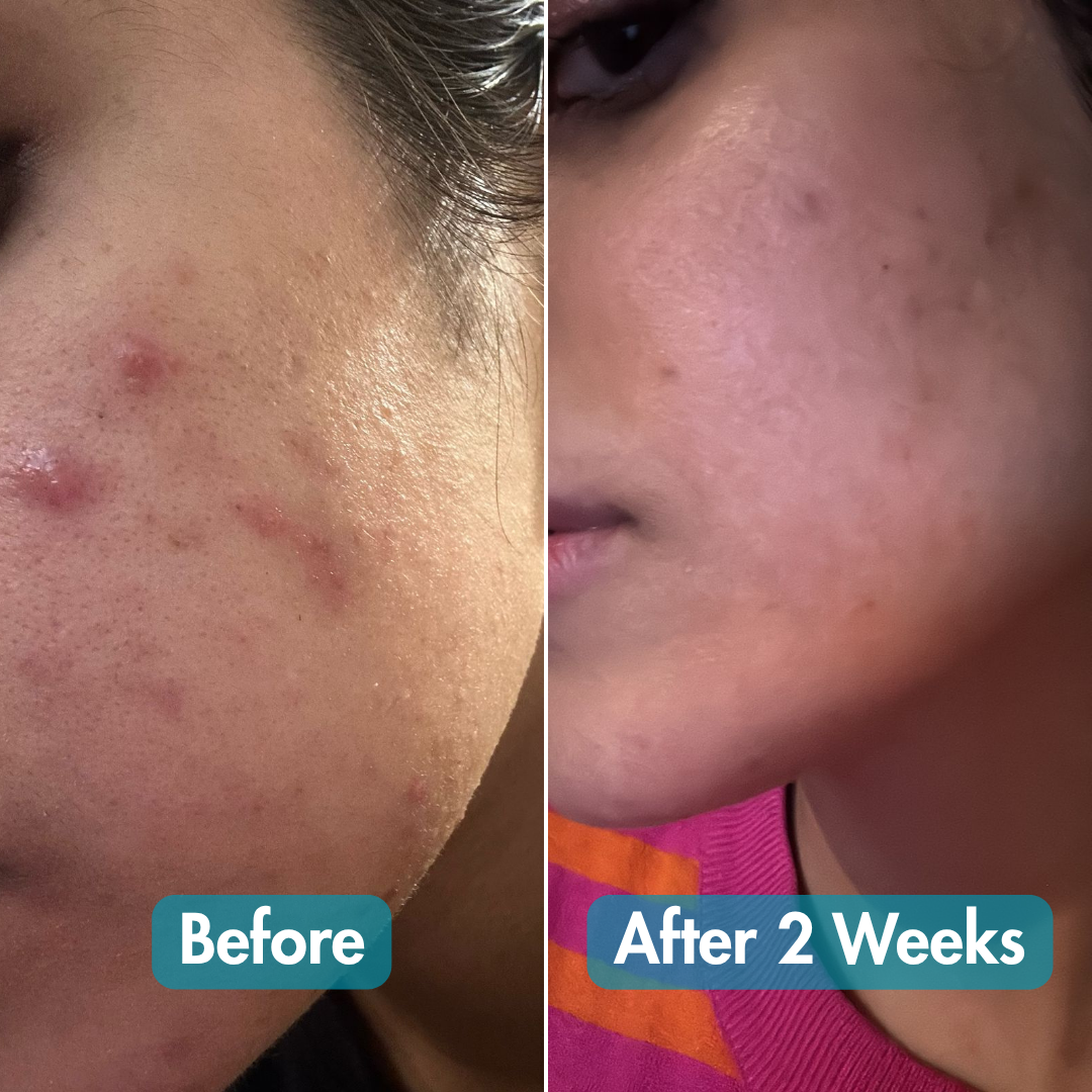 Ultimate Clear Anti - Acne Kit